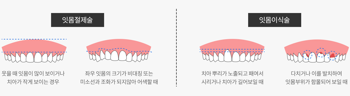 잇몸사진